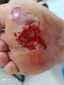 Diabetic foot