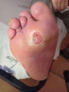糖尿病性足
