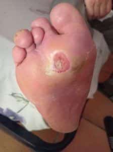 Diabetic foot